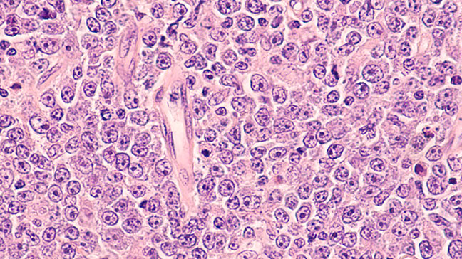Lymphomes B Diffus à grandes cellules